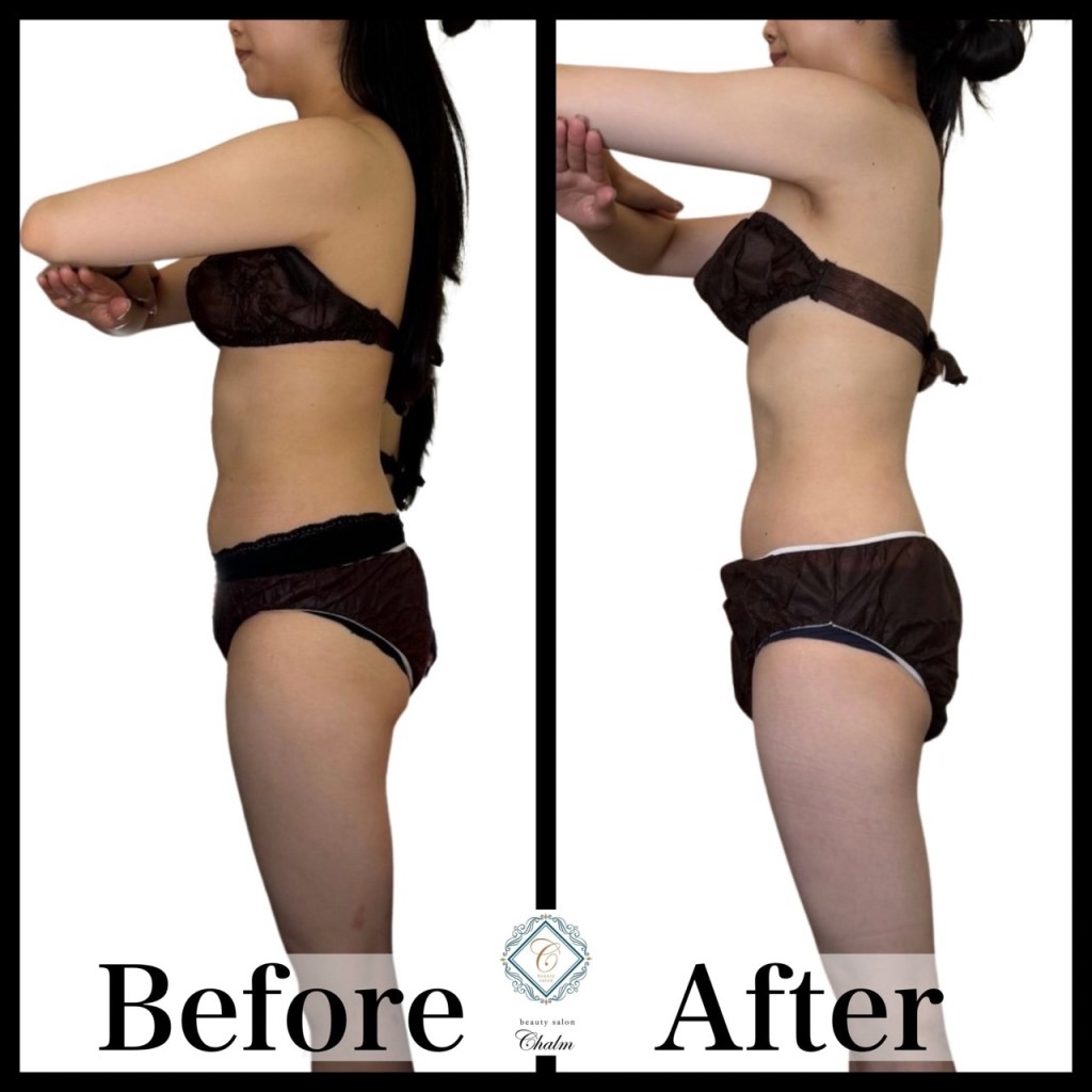 レディース痩身 ビフォーアフター