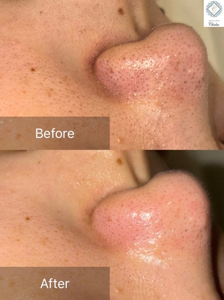 ヒト幹細胞美容液導入 ビフォーアフター